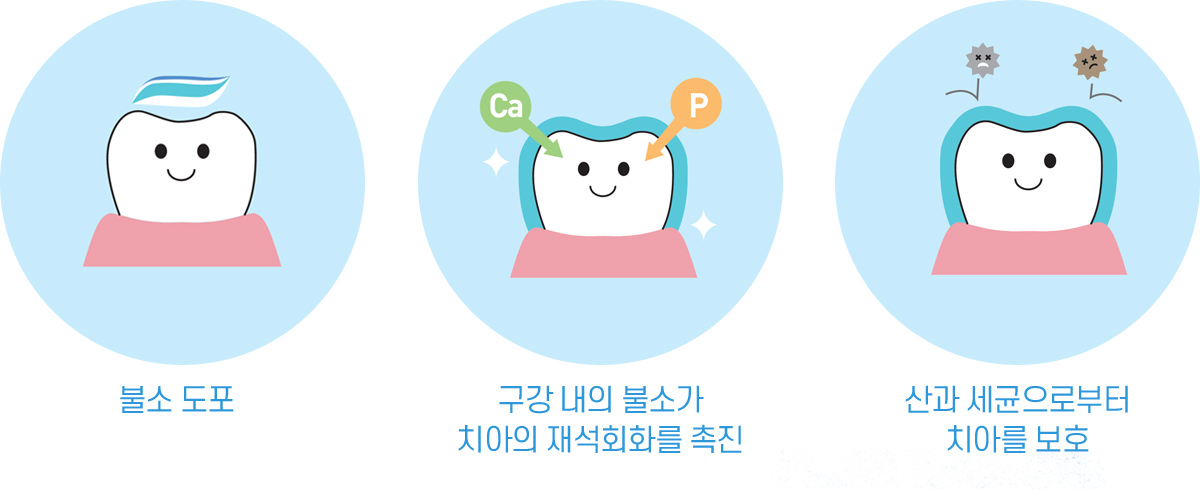 불소 도포/구강 내의 불소가 치아의 재석회화를 촉진/산과 세균으로부터 치아를 보호